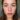 Acne Pimples