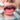 Mouth Ulcers Treatment in Homeopathy