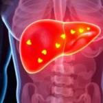 Fatty liver disease has emerged as one of the most common health concerns worldwide. It occurs when excessive fat accumulates in liver cells, impairing the organ’s ability to function efficiently. While early stages often remain unnoticed, prolonged neglect can lead to inflammation, fibrosis, or even cirrhosis. Factors such as poor diet, sedentary lifestyle, and alcohol consumption contribute significantly to its rise. Alongside conventional medical approaches, many patients are turning to homeopathy for a natural, holistic method that not only addresses symptoms but also supports liver detoxification, digestion, and overall metabolic balance. This article explores causes, symptoms, diagnosis, conventional and homeopathic treatments, key remedies, lifestyle guidance, and recovery strategies for fatty liver. What are Fatty Liver Disease The liver is the body’s largest internal organ, responsible for filtering toxins, producing bile, and storing essential nutrients. Fatty liver, also called hepatic steatosis, develops when fat exceeds 5–10% of the liver’s weight. There are two primary types: Non-Alcoholic Fatty Liver Disease (NAFLD): Linked to obesity, diabetes, and poor dietary habits. NAFLD affects millions globally and is a leading cause of chronic liver disease. Alcoholic Fatty Liver Disease: Caused by prolonged, excessive alcohol consumption, which hampers fat metabolism in the liver. If untreated, fatty liver can progress to non-alcoholic steatohepatitis (NASH), fibrosis, cirrhosis, or even liver cancer. Early detection and management are crucial for reversal. Causes and Risk Factors of Fatty Liver Understanding the underlying causes helps prevent and manage liver dysfunction effectively. Common contributors include: Obesity and Overweight: Extra body fat increases fat storage in the liver. Insulin Resistance and Type 2 Diabetes: Impaired sugar metabolism promotes fat accumulation. Alcohol Consumption: Directly toxic to liver cells, leading to fatty degeneration. High Cholesterol and Triglycerides: Disrupted lipid metabolism stresses the liver. Sedentary Lifestyle: Lack of exercise slows fat breakdown and metabolism. Genetics and Family History: Some individuals develop fatty liver despite being at a normal weight. Identifying these risk factors early can guide lifestyle adjustments and treatment. Common Symptoms and Diagnosis The liver often remains silent in early stages. Many individuals only discover it during routine health check-ups. However, as fat builds up, specific symptoms may appear: Persistent fatigue and general weakness Heaviness or dull pain in the upper right abdomen Bloating, indigestion, or sluggish digestion Loss of appetite or occasional nausea Advanced liver damage may manifest as jaundice, leg swelling, confusion, or unexplained weight loss. Diagnosis: Blood Tests: Elevated liver enzymes (ALT, AST) indicate liver stress. Imaging: Ultrasound, CT scan, or MRI to detect fat deposits. Liver Biopsy: Rarely required, but provides a precise disease stage Conventional Treatment Approaches Modern medicine emphasizes lifestyle modification as the cornerstone of liver management: Weight loss through a balanced diet and regular exercise Alcohol cessation in alcohol-related fatty liver Controlling diabetes, cholesterol, and blood pressure Medications for associated conditions, as no drug directly reverses liver damage While conventional medicine focuses on disease control, homeopathy complements it by supporting natural liver healing and metabolic balance. Homeopathic Approach to Fatty Liver Homeopathy views fatty liver as a systemic imbalance rather than a local issue. Treatment is individualized, considering a patient’s constitution, digestion, mental state, and lifestyle. Key principles include: Constitutional Remedies: Tailored to the person’s overall health, not just the liver symptoms. Drainage Remedies: Promote liver detoxification and bile flow. Holistic Care: Supports digestion, metabolism, and overall vitality. Unlike suppressive treatments, homeopathy gently stimulates the liver’s natural healing capacity, aiming to prevent disease progression. Best Homeopathic Medicines for Fatty Liver Chelidonium Majus One of the most crucial liver remedies, Chelidonium, is indicated when there is right-sided abdominal pain, a yellow-coated tongue, and an intense craving for hot drinks. It suits patients with jaundice tendencies and sluggish digestion. Carduus Marianus Known as a powerful liver tonic, Carduus is beneficial for liver congestion, fatty degeneration, and alcohol-related liver complaints. It helps in cases where there is pain under the ribs, nausea, and vomiting of green fluid. Nux Vomica Best suited for individuals with a sedentary lifestyle, excessive intake of alcohol, coffee, or rich food, and digestive troubles. It addresses irritability, bloating, constipation, and liver pain that worsen in the morning. Lycopodium Clavatum Indicated when there is chronic liver enlargement, fullness after small meals, excessive gas, and craving for sweets. It works well for patients who are thin above but have a large belly. Phosphorus Helpful in cases of fatty degeneration, weakness, bleeding tendencies, and sensitivity to food odors. It suits lean, tall individuals who often suffer from anxiety or nervous exhaustion. Calcarea Carbonica Best suited for obese patients with slow metabolism, excessive sweating, and craving for eggs. It is valuable when fatty liver is linked with weight gain and sluggish digestion. Why Choose Homeopathy for Fatty Liver? Unlike conventional medicine, which often focuses on symptom suppression, homeopathy views the liver as part of a larger systemic imbalance. A homeopath studies not only your liver symptoms but also your emotional patterns, cravings, and overall health history. This holistic approach often leads to deeper and longer-lasting results. Moreover, remedies are non-toxic, safe for long-term use, and suitable even for children or pregnant women (under professional supervision). Lifestyle and Natural Care While homeopathy provides individualized treatment, lifestyle changes are equally vital for reversing fatty liver disease. Balanced Diet: Focus on fresh fruits, vegetables, whole grains, lean proteins, and omega-3 rich foods like flaxseeds and walnuts. Avoid Alcohol & Sugary Foods: Both significantly worsen liver fat accumulation. Regular Exercise: At least 30 minutes of brisk walking or yoga daily can improve liver function. Weight Management: Gradual weight loss of 5–10% can reverse the liver in many cases. Hydration: Drinking enough water supports liver detoxification. Combining homeopathy with these natural measures enhances healing and prevents disease progression. Recovery and Prognosis The good news is that fatty liver is reversible in early stages with proper treatment and lifestyle changes. Homeopathic remedies support detoxification, improve digestion, and prevent progression. Recovery time varies: Mild fatty liver: noticeable improvement in 3–6 months. Moderate cases: may take 6–12 months with consistent care. Advanced cases: require close monitoring, sometimes combining conventional and homeopathic care. When to Seek Medical Help While homeopathy offers gentle and practical support, patients must seek urgent medical attention if they experience: Severe abdominal pain or swelling Yellowing of skin and eyes (jaundice) Vomiting blood or black stools Confusion or disorientation These could signal serious liver complications needing hospital care. Conclusion Fatty liver disease is a silent but serious condition that can progress if ignored. Homeopathy provides a natural, holistic approach by addressing the root causes, improving digestion, and stimulating the liver’s healing ability. Remedies such as Chelidonium, Carduus Marianus, Nux Vomica, Lycopodium, Phosphorus, and Calcarea Carbonica are especially valuable when prescribed according to individual symptoms. When combined with a balanced diet, regular exercise, and a healthy lifestyle, homeopathy can play a vital role in reversing liver damage and restoring long-term liver health. Consulting a qualified homeopathic physician ensures safe and effective treatment tailored to your unique needs. "So, what's my final advice? Please don't take a fatty liver diagnosis lightly, but also don't panic. From my clinical experience, I can tell you that the liver has an incredible ability to heal itself, provided you give it the right support. By working with your doctor to get a proper diagnosis and exploring supportive therapies like homeopathy, you can address the root cause and reverse the damage. Your health is in your hands, and homeopathy can be a powerful tool to help you on your journey to a healthier liver and a healthier life." Frequently Asked Questions What is the best natural remedy for a fatty liver? A balanced diet, regular exercise, and liver-friendly foods like turmeric, lemon water, and green vegetables are considered the best natural remedies. In homeopathy, remedies such as Chelidonium Majus and Carduus Marianus are often prescribed for liver support. What is the best medicine to reduce fatty liver? Conventional medicine has no single drug for the liver, but lifestyle changes are the cornerstone. In homeopathy, remedies such as Nux Vomica, Lycopodium, and Phosphorus are commonly used based on individual symptoms. How to get rid of fatty liver in 30 days? The liver cannot usually be reversed in just 30 days. However, reducing alcohol, following a liver-friendly diet, exercising daily, and starting homeopathic treatment can show early improvements within weeks. What is the best herb for liver repair? Milk thistle (Carduus Marianus) is considered one of the best herbs for liver repair. Homeopathy also uses this remedy in potentized form for liver and liver congestion. What spice is good for fatty liver? Turmeric is one of the most beneficial spices for the liver due to its anti-inflammatory and antioxidant properties. Is Ashwagandha good for fatty liver? Yes, Ashwagandha may help by reducing stress, improving metabolism, and supporting liver health, though it should be used under professional guidance.